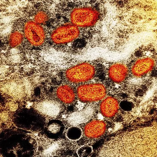 This iamge provided by the National Institute of Allergy and Infectious Diseases (NIAID) shows a colorized transmission electron micrograph of monkeypox particles (orange) found within an infected cell (brown), cultured in the laboratory. This image was captured at the NIAID Integrated Research Facility (IRF) in Fort Detrick, Md. The World Health Organization recently declared the expanding monkeypox outbreak a global emergency.  It is WHO’s highest level of alert, but the designation does not