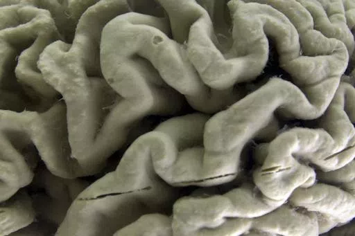 A section of a human brain with Alzheimer's disease is displayed at the Museum of Neuroanatomy at the University at Buffalo, in Buffalo, N.Y., Oct. 7, 2003. A long-feared gene appears to do more than raise people’s risk of Alzheimer’s: Inheriting two copies can cause the mind-robbing disease, according to research published in the journal Nature Medicine on Monday, May 6, 2024. (AP Photo/David Duprey, File)