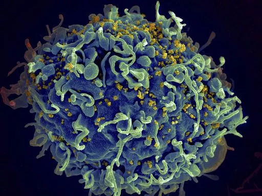 This electron microscope image made available by the U.S. National Institutes of Health shows a human T cell, in blue, under attack by HIV, in yellow, the virus that causes AIDS. Three women who were diagnosed with HIV after getting “vampire facial” procedures at an unlicensed New Mexico medical spa are the first believed to have contracted the virus through a cosmetic procedure using needles, according to federal health officials. (Seth Pincus, Elizabeth Fischer, Austin Athman/National Inst